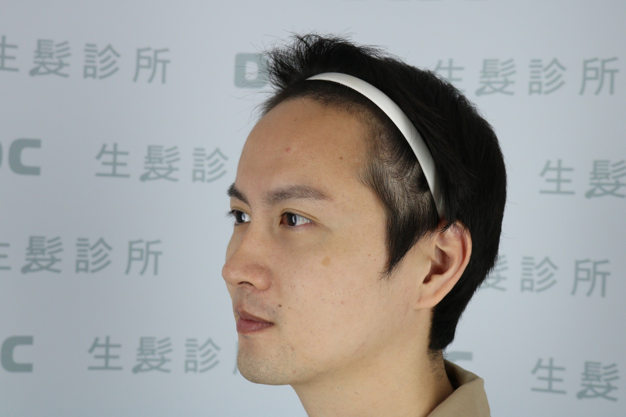 DCDC生髮診所-男性前額髮際線稀疏與額角後縮術前正面檢視